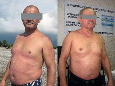 Russian Medical Doctor Treats Psoriasis with Deta Bioresonance devices