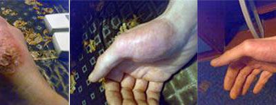 Severe eczema on hands cured with Deta-Elis AP